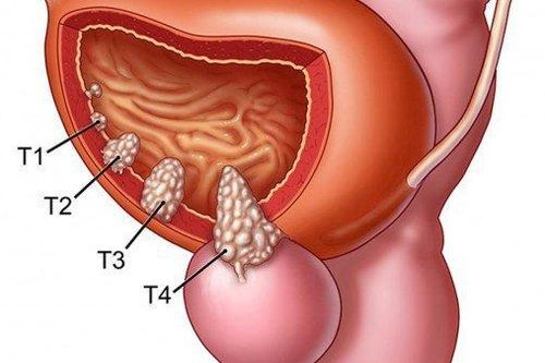 Liệu pháp kết hợp thuốc giúp kéo dài cuộc sống bệnh nhân ung thư bàng quang