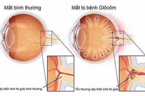 Thiên đầu thống: Phát hiện sớm, ngừa biến chứng nguy hiểm