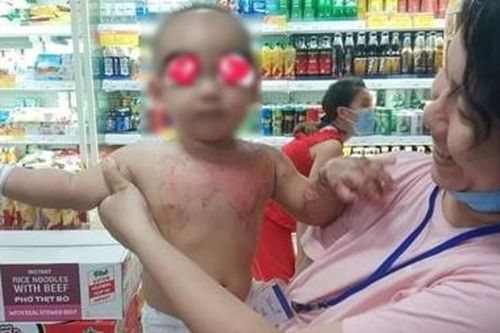 Cấp cứu bé 2 tuổi bị bỏng từ nước sôi nấu mì gói
