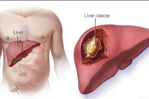 Uống rượu, hút thuốc vô tội vạ, đàn ông Việt coi chừng ung thư gan, phổi