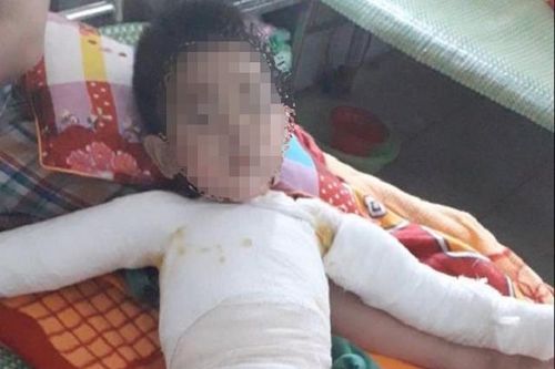 Ghép da 3 lần, bệnh nhi 5 tuổi bị bỏng nặng toàn thân được cứu sống