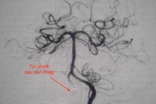 Cứu sống bệnh nhân 2 lần ngưng tim