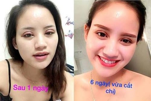 Cắt mí và những điều cần lưu ý
