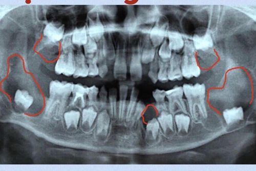 Bệnh viện Đa khoa tỉnh Khánh Hòa: Điều trị thành công cho bệnh nhi bị nhiều tổn thương dạng nang xương hàm