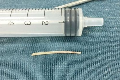 Chiếc xương cá 3cm nằm trong cổ bé gái gần nửa năm