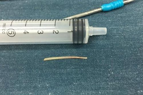 Bé gái bị hóc xương cá, 5 tháng sau mới lấy ra khỏi cổ họng