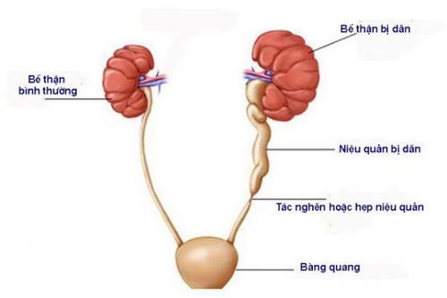 Điều trị hẹp niệu quản với 'vũ khí' mới