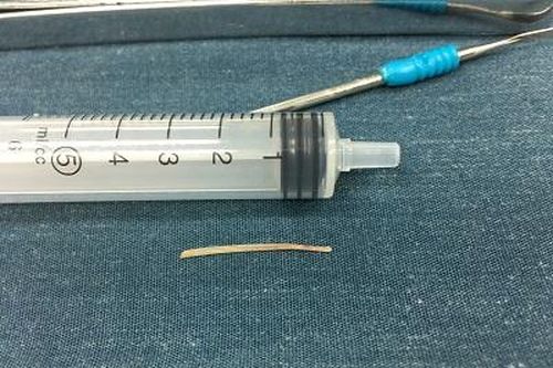 Hóc xương cá, bé gái chữa dân gian vùng cổ nổi u