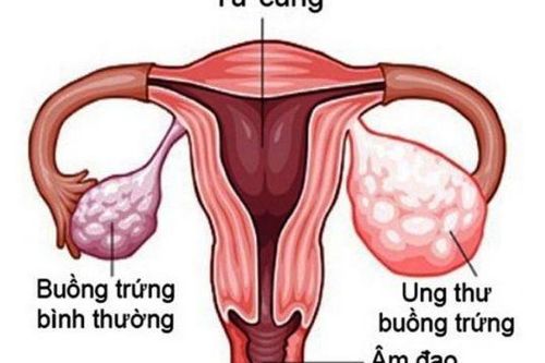 Olaparib kéo dài thời gian sống cho bệnh nhân ung thư buồng trứng