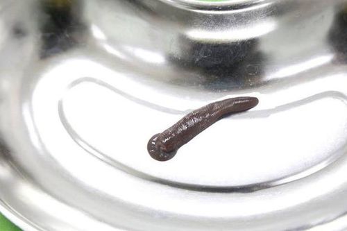 Gắp con đỉa suối dài 5 cm trong hốc mũi người phụ nữ