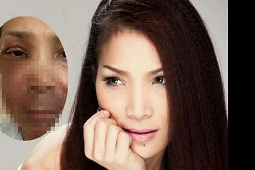 Hồng Ngọc chia sẻ hình ảnh gương mặt bị bỏng để cảnh tỉnh mọi người