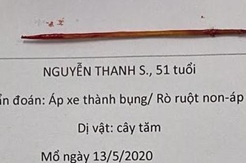 Tăm xỉa răng dài 6cm đâm thủng thành bụng