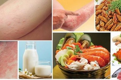 Ăn uống khi bị mề đay 'hỏi thăm'
