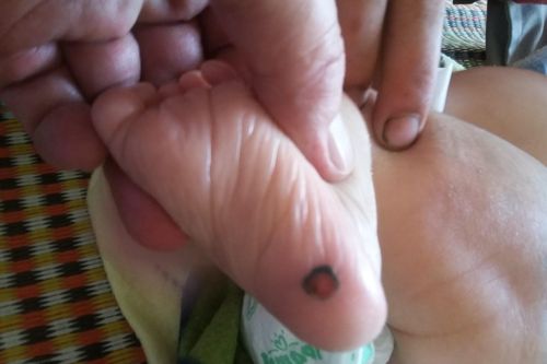 Bé một tháng tuổi mắc bệnh giang mai