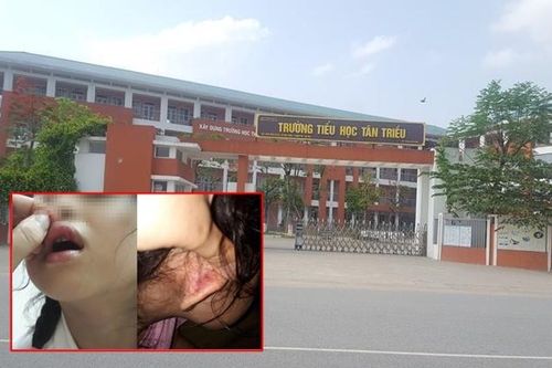 Giáo viên chủ nhiệm lên tiếng phủ nhận việc tát chảy máu, dập môi học sinh lớp 2 vì làm sai bài Toán