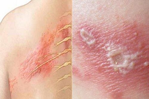 Ðối phó với đau sau zona thần kinh
