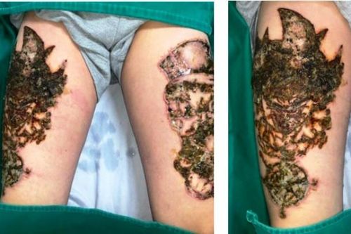 Hà Nội: Nam thanh niên 'nát bét' hai đùi vì biến chứng xóa xăm
