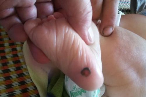 Bé trai 1 tháng ở Yên Bái đã mắc bệnh giang mai