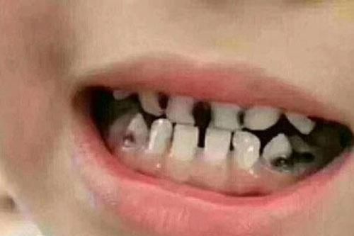 Miệng bé 3 tuổi đầy 'răng đen', không phải vì đường, mà là hai thói quen này của nhiều bố mẹ