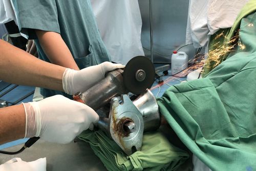 Cấp cứu một phụ nữ bị cuốn tay vào máy xay thịt