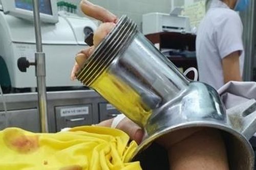 Người phụ nữ nhập viện với chiếc máy xay thịt 'ngoạm' hết bàn tay