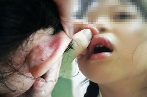 Cô giáo bị tố đánh học sinh bầm tím: Kết quả giám định pháp y ra sao?