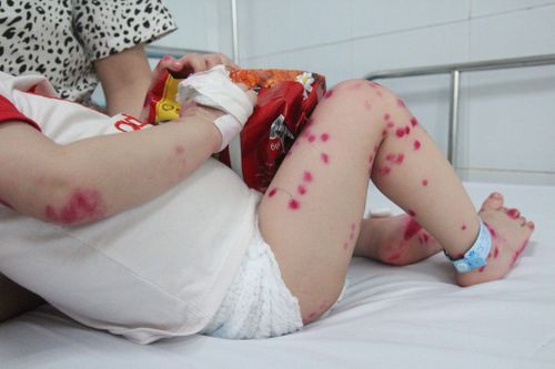 Trẻ ăn chung bát dễ mắc tay chân miệng