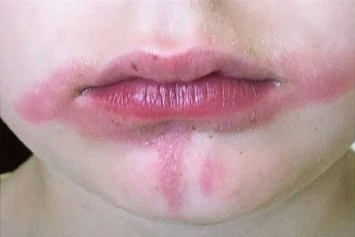 Cậu bé bỏng khắp miệng sau khi ăn kem chanh, nguyên nhân khiến gia đình bất ngờ