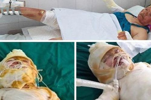 Chồng mất, 3 mẹ con bị bỏng nặng sau vụ cháy điều hòa đang rất cần sự giúp đỡ