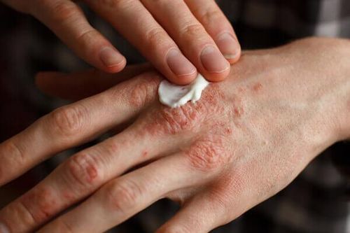 Phát hiện sớm biến chứng bệnh vảy nến