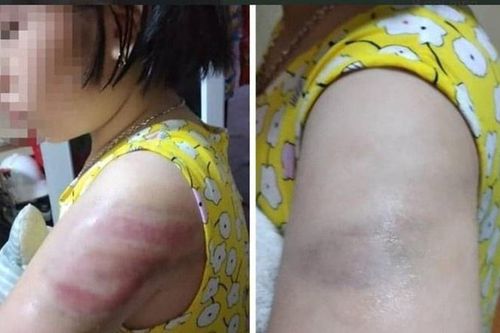 Sở GD&ĐT Nam Định đề nghị xử lý nghiêm cô giáo đánh tím tay học sinh