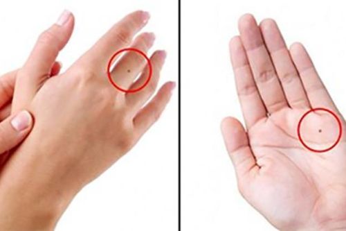 Sở hữu nốt ruồi ở tay vị trí 'vàng son' cả đời tiêu không hết tiền
