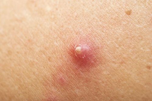 Cảnh báo về biến chứng rất nguy hiểm của bệnh 'hậu bối'