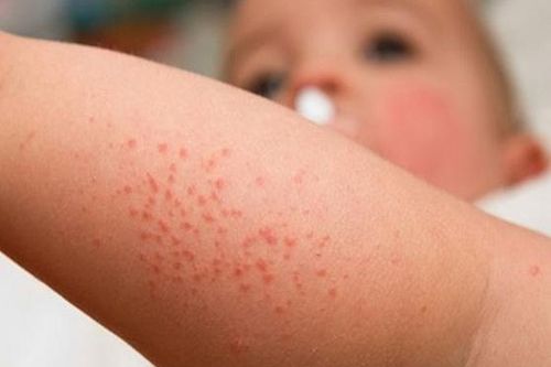Ngừa bệnh ngoài da cho bé khi trời nóng