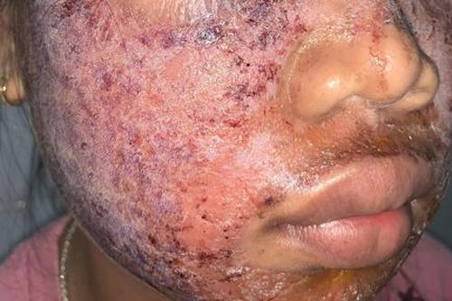 Gương mặt thiếu nữ 17 tuổi bị lở loét vì lột da làm trắng