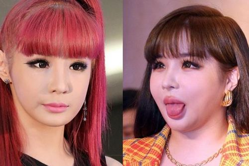 Park Bom trước khi lộ mặt sưng phù biến dạng