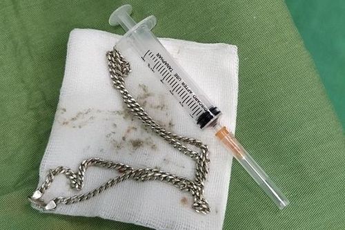 Bé 29 tháng tuổi nuốt sợi dây chuyền vào bụng