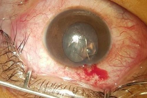 Quảng Bình: Cấp cứu kịp thời bệnh nhân bị mảnh sắt bắn thủng giác mạc