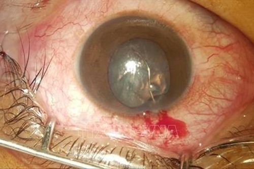 Quảng Bình: Cấp cứu kịp thời bệnh nhân bị mảnh sắt bắn thủng giác mạc