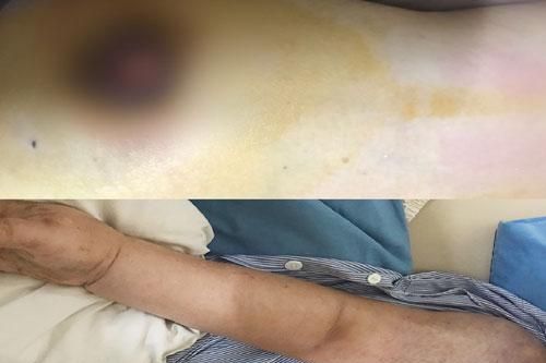 Đắp lá chữa ung thư vú, một phụ nữ bị di căn xương giai đoạn cuối