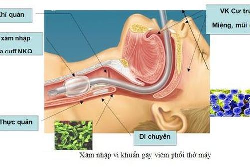 Thuốc mới trị viêm phổi mắc phải ở bệnh viện