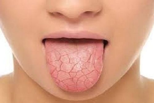 Đau rát miệng - Dấu hiệu không nên bỏ qua