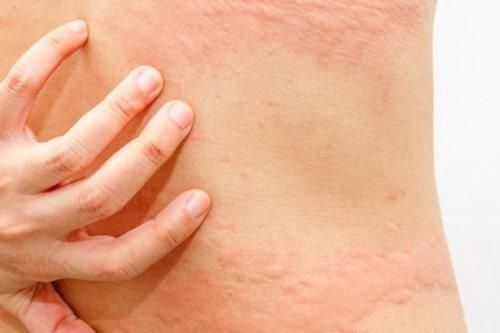 Mách bạn cách trị ngứa sâu róm hiệu quả nhất