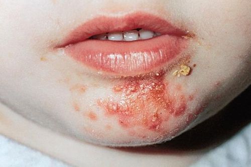 Bệnh chốc có lây lan?