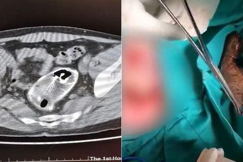 Ngồi lên cá rô phi, người đàn ông đau đớn vì bị cá chui trực tràng