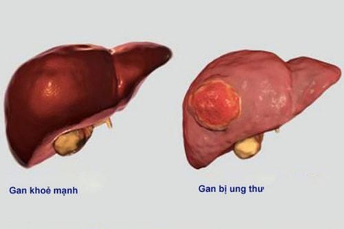 Dấu hiệu '1 đỏ, 2 vàng, 1 đen' cảnh báo ung thư gan đang ''trú'' trong người bạn