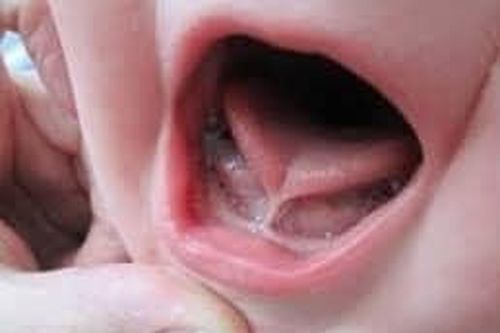 Hàng trăm trẻ chậm nói, đi khám mới biết bị dính lưỡi