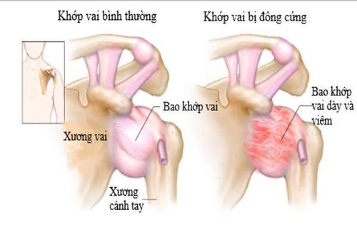 Biến chứng cơ xương khớp do đái tháo đường