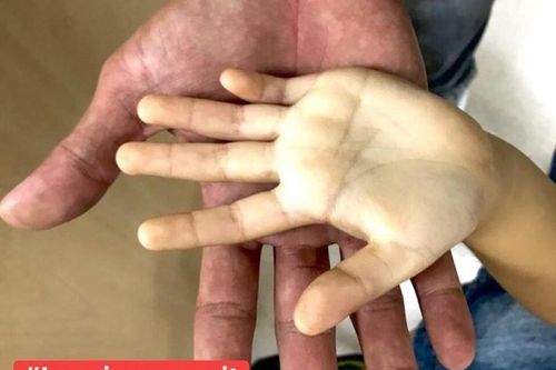 Uống 10 hộp sữa tươi mỗi ngày bé gái 3 tuổi bị thiếu máu trầm trọng