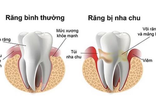 Bệnh viêm nha nhu và cách điều trị
